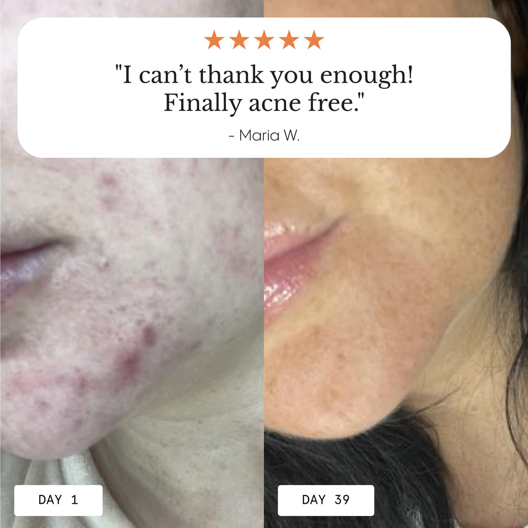 Acne Breakouts – Froya Organics